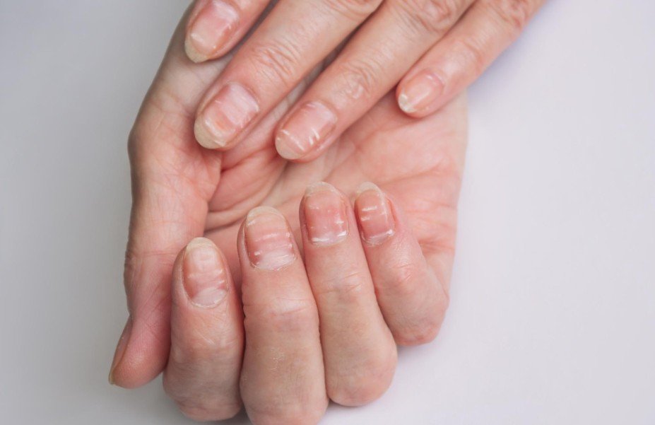 10 Signs of Unhealthy Fingernails You Should Never Ignore