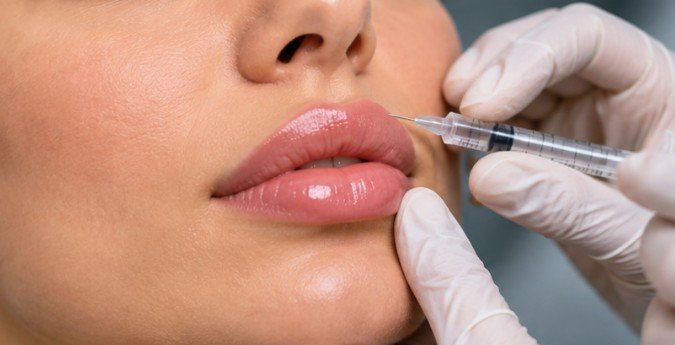 How Long Do Hydro Lip Fillers Last? A Realistic Timeline