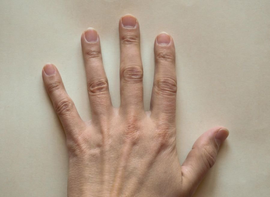 Thickened or Crumbling Nails